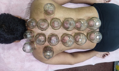 Cupping therapy